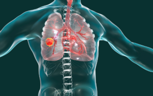 Carcinoma broncogênico: um tipo de tumor que mais faz vítimas no mundo.