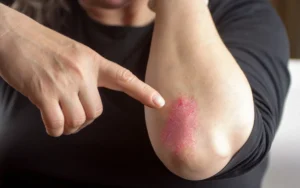 Psoríase: doença inflamatória da pele.