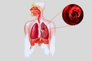 Embolia pulmonar tem como causa inicial a formação de coágulos sanguíneos.