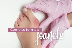 Imagem apresenta o pé de uma mulher com vermelhidão no joanete.