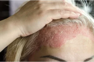 Lúpus eritematoso doença inflamatória crônica que ataca o organismo e os tecidos.