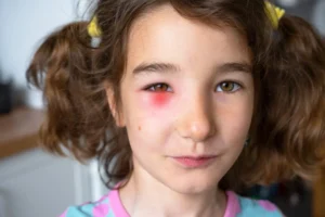 Menina com a pálpebra inchada e vermelhidão, um dos sinais da conjuntivite.