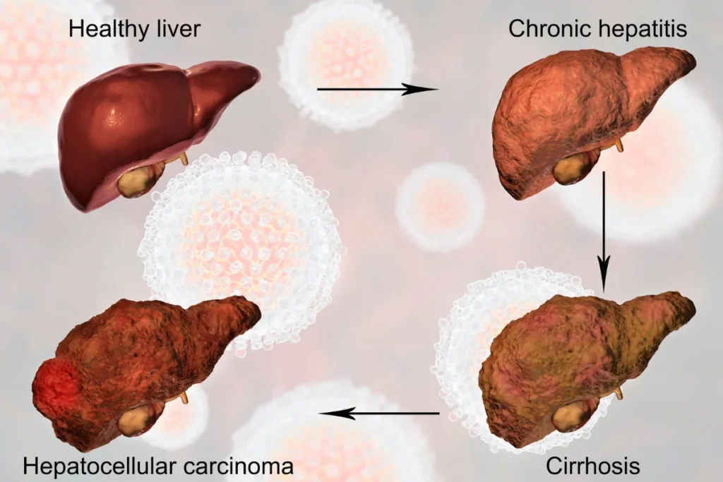 Fígado e suas complicações, como hepatite crônica, cirrose e carcinoma hepatocelular. (Imagem: Canva)