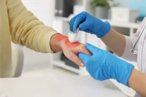 Médica tratando a mão com queimaduras da paciente.